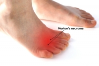 What Is Morton’s Neuroma?