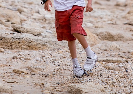 clubfoot