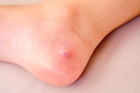 What Causes Blisters on the Feet?