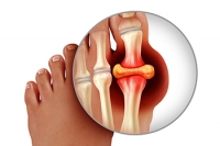 Severe Pain Can Accompany Gout