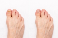 Toenail Fungus Progression and Treatment