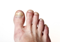 Are You at Risk of Toenail Fungus?