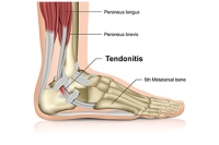 Achilles Tendon Injuries in Children