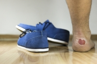 What You Need to Know About Foot Blisters