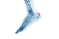 Causes of an Achilles Heel Spur