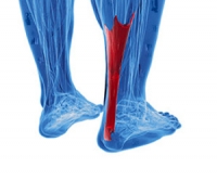 An Overview of Achilles Tendonitis