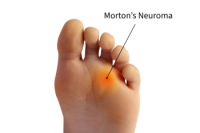 Managing Morton’s Neuroma