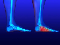 Conditions That Can Cause Flat Feet